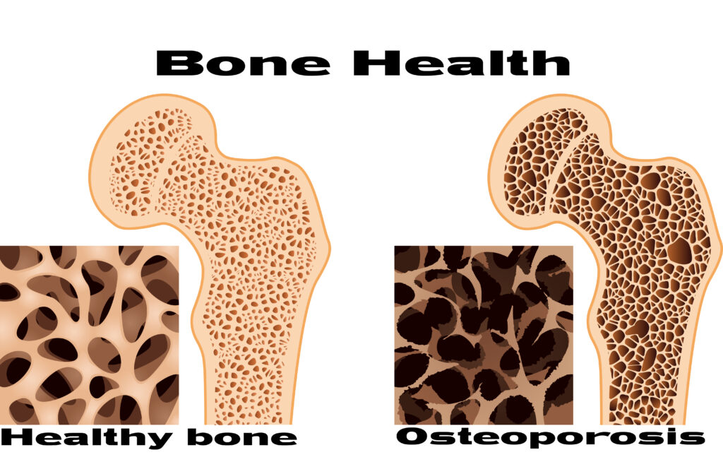 It S Never Too Soon To Safeguard Your Bones Comprehensive Orthopaedics