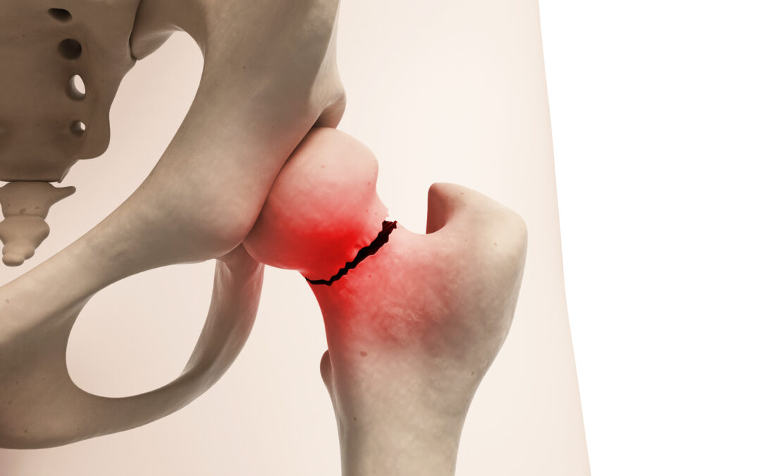 Don’t Delay Hip Fracture Surgery. Here’s Why