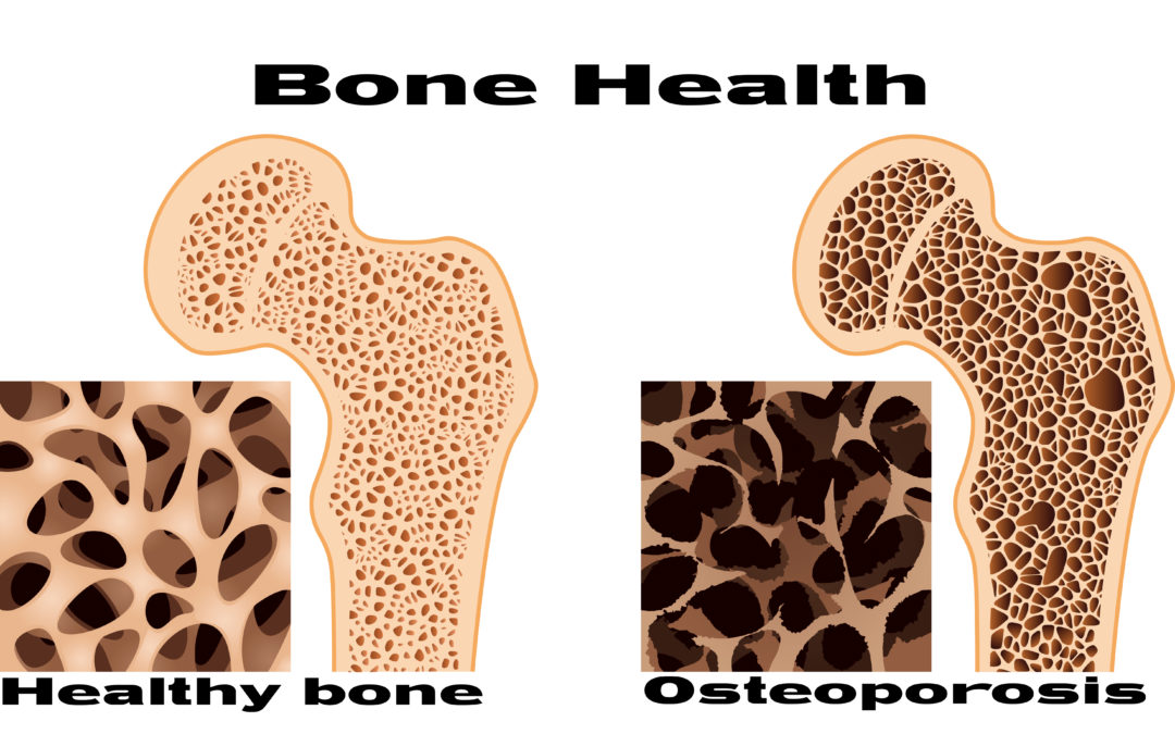 It’s Never Too Soon to Safeguard Your Bones
