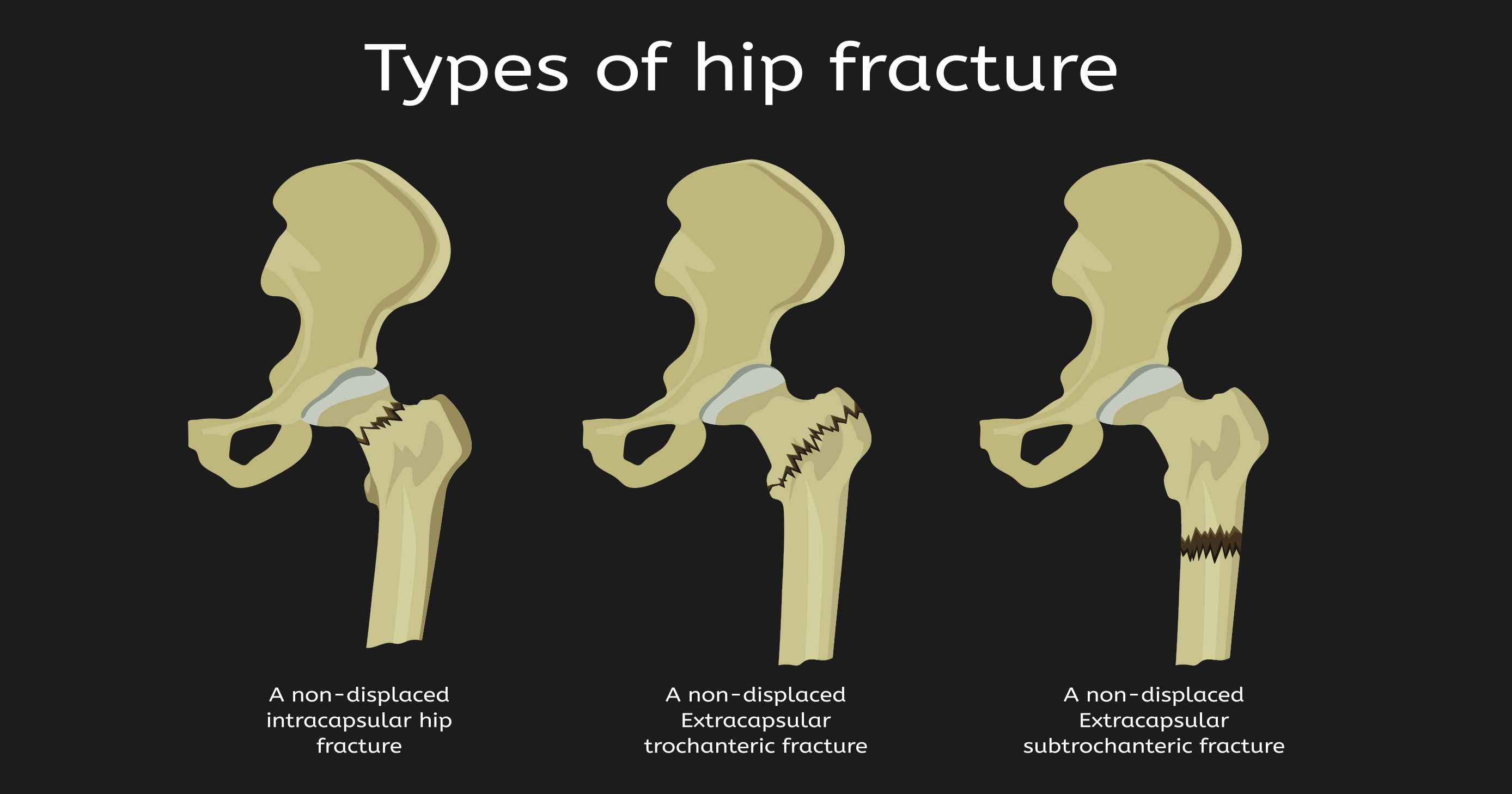 Can You Still Walk If You Break Your Hip