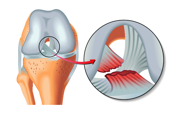 ACL Surgery Preparation and Recovery