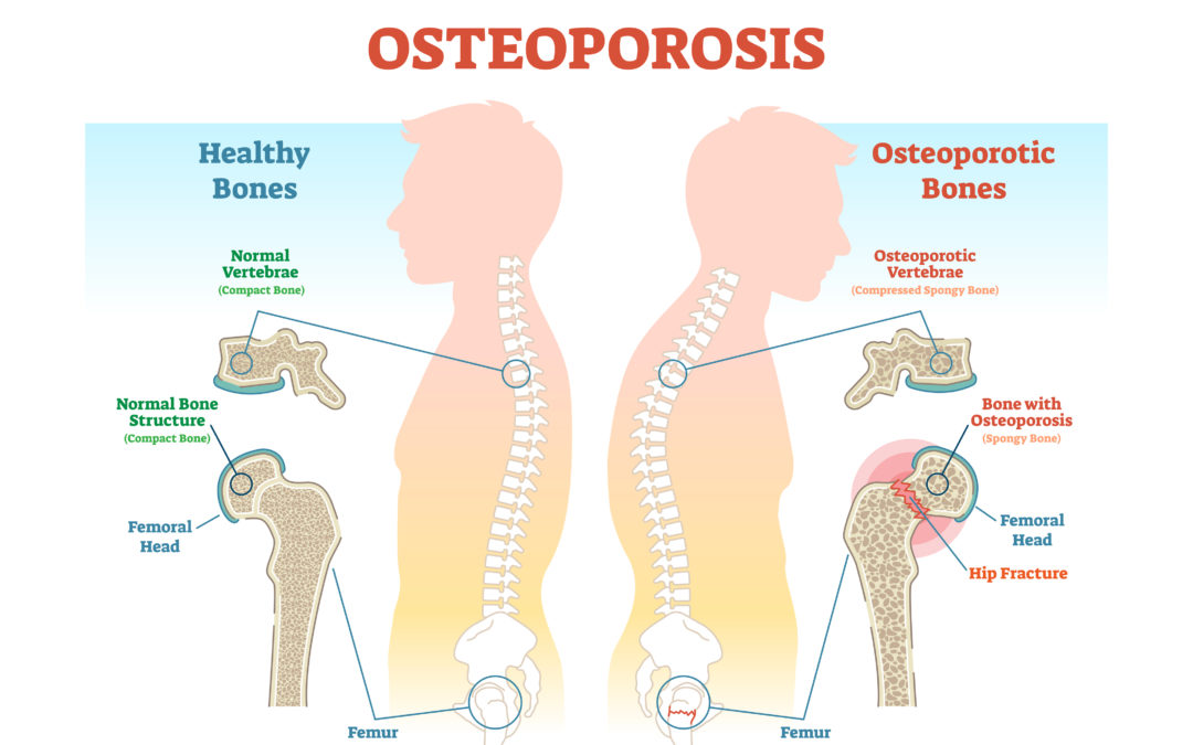 Health Tip: Risk Factors for Male Osteoporosis