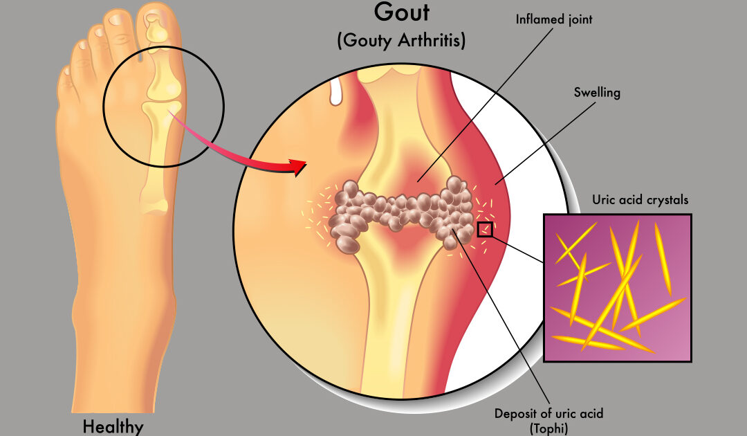 Younger Gout Patients Have Higher Odds for Blood Clots