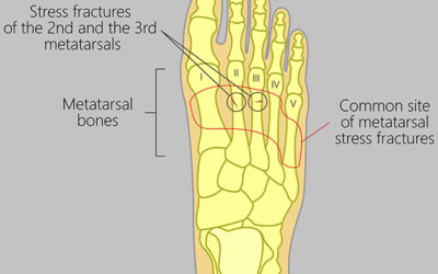 Health Tip: Preventing Stress Fractures