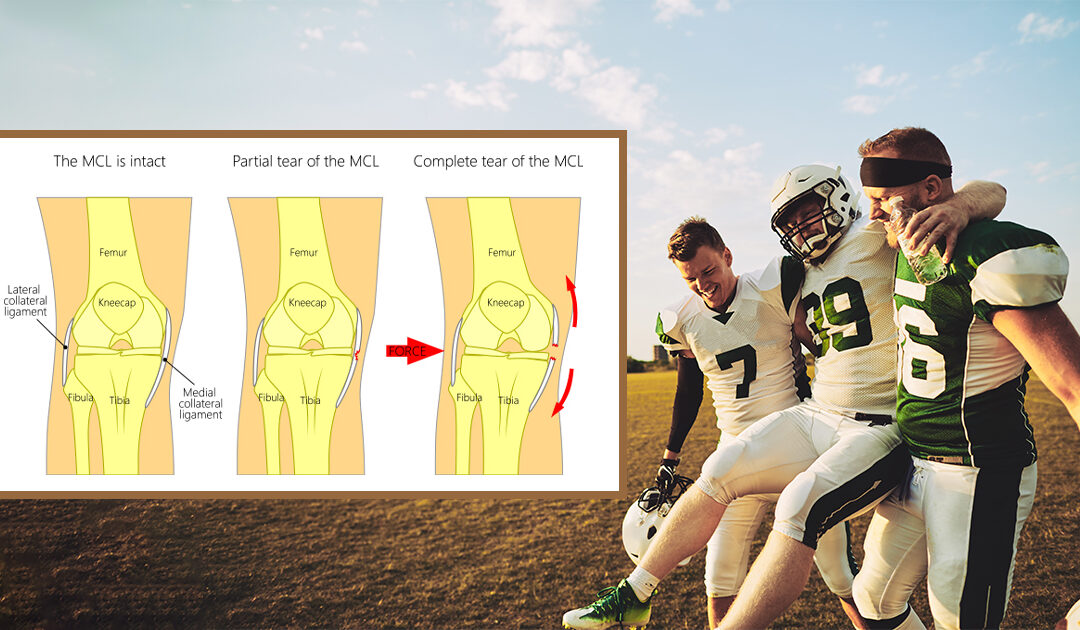 MCL tear of the knee: Injury, diagnosis, treatment 