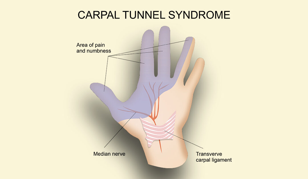 Not Just Keyboards: Many Types of Workers Can Develop Carpal