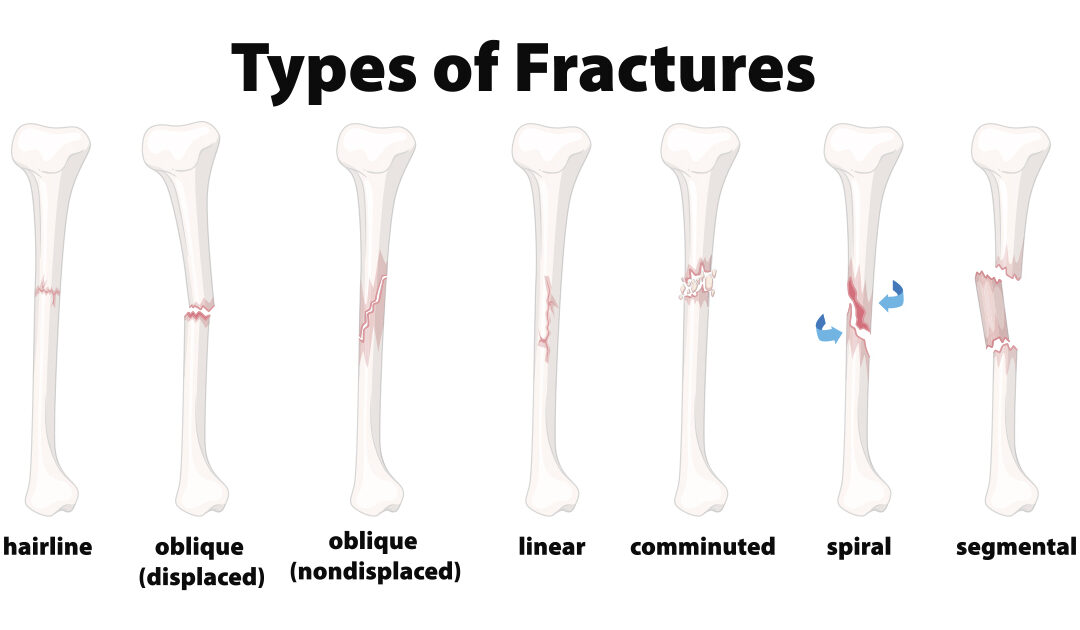 Understanding the Different Types of Bone Fractures - Comprehensive  Orthopaedics