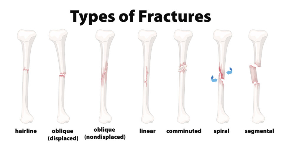 Understanding the Different Types of Bone Fractures - Comprehensive ...