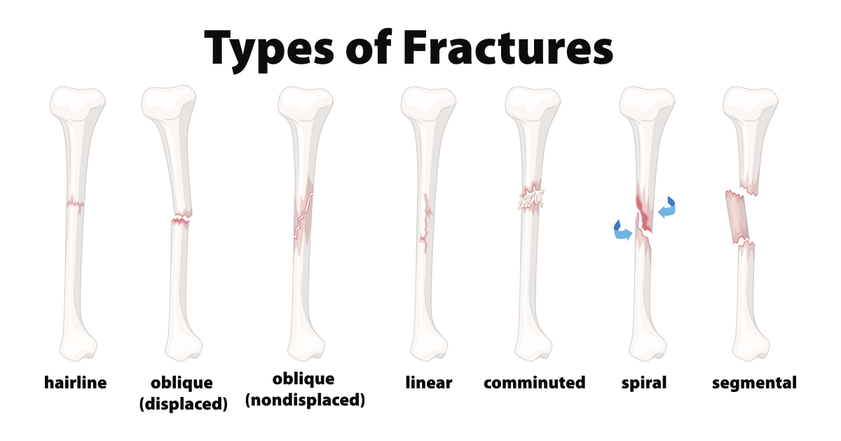 oblique fracture