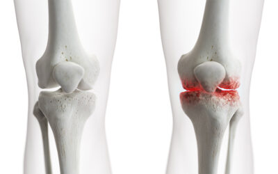 Are Cortisone Injections Good or Bad for Arthritic Knees?