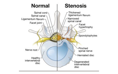 Sciatica: What Is It, and How Can You Ease the Pain?