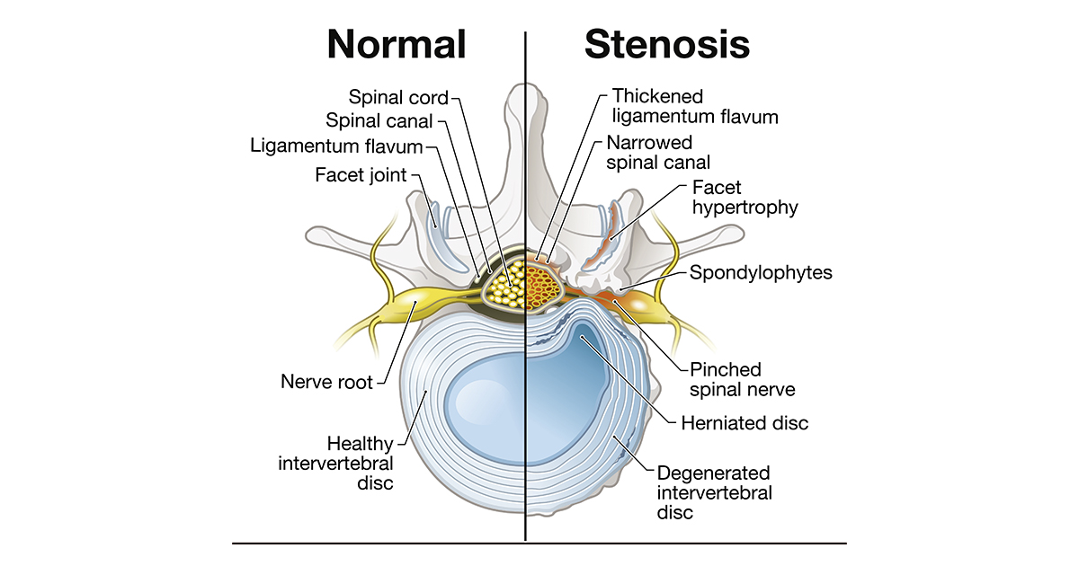 Spinal Stenosis  Diagnosing & Treatment Options: Progressive Spine &  Sports Medicine: Pain Medicine