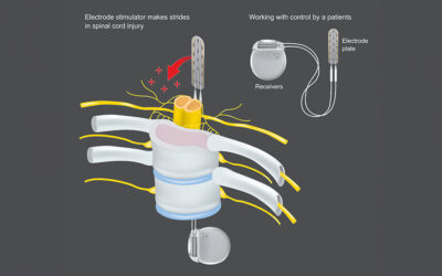 Spinal Cord Stimulation Eases Pain, Boosts Function for People With Prosthetic Legs